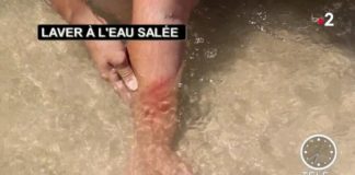 Les bon gestes en cas de morsures ou de piqûres Sante-Morsures-ou-piqures-les-bons-gestes