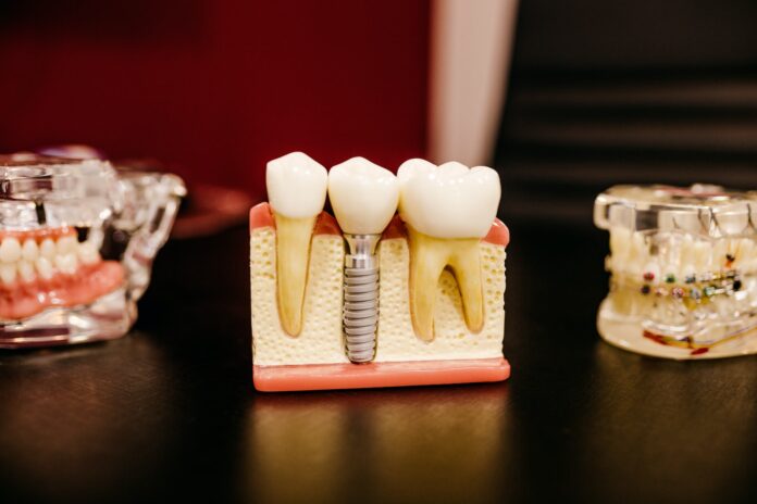 Implant dentaire : comment ça fonctionne ?