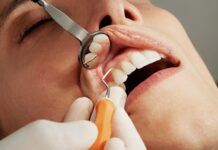 Tout savoir sur les caries Tout savoir sur les caries