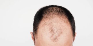 Greffe de cheveux : quand réaliser cette opération ? Greffe de cheveux : quand réaliser cette opération ?