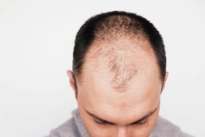 Greffe de cheveux : quand réaliser cette opération ?