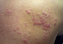 Traiter le zona Traiter le zona