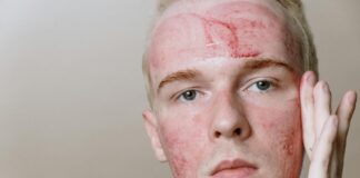 Stress et acné : stratégies pour réduire les impacts Stress et acné : stratégies pour réduire les impacts